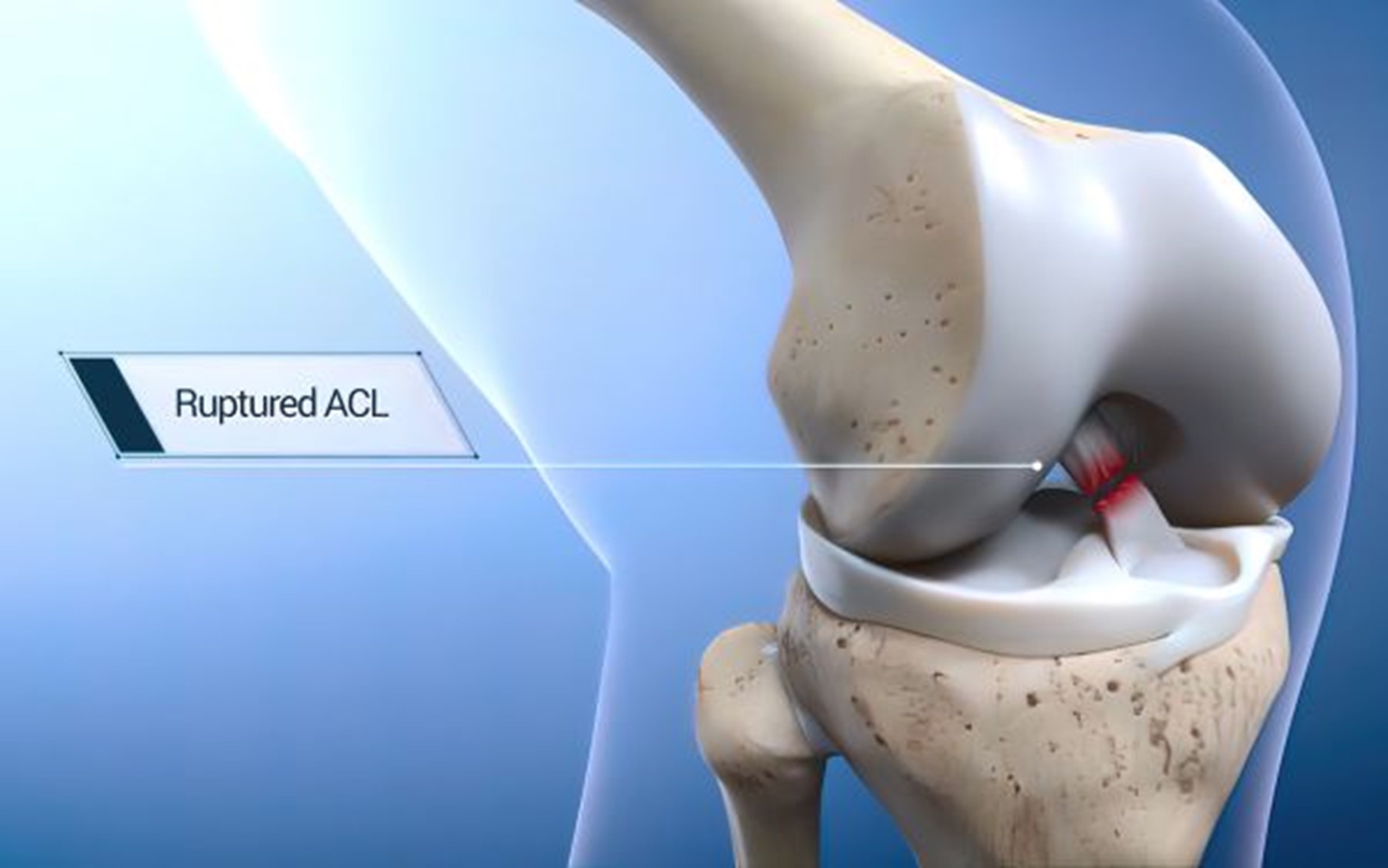 Understanding ACL Injuries: Causes, Symptoms, Treatment, and Prevention