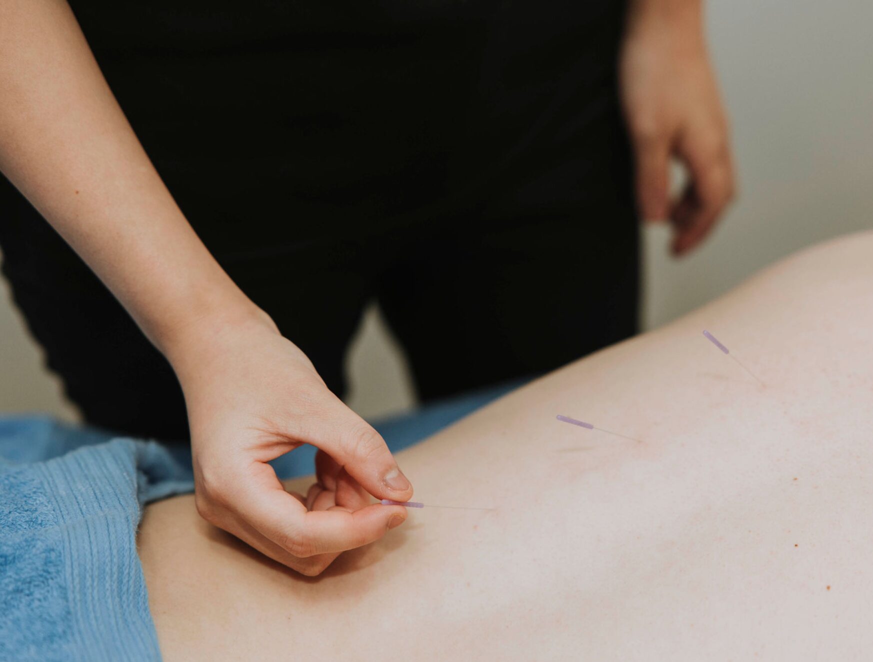 Precision Healing: The Benefits of Physiotherapy Dry Needling