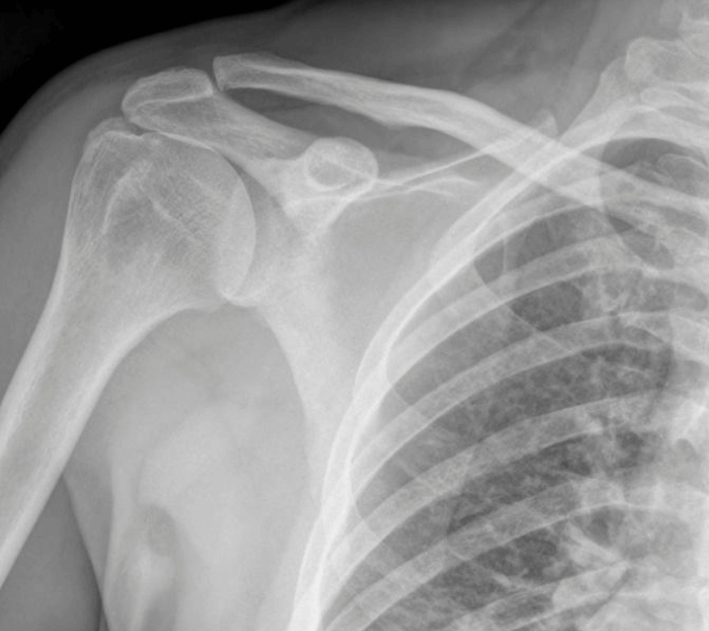 Physiotherapy for Rotator Cuff Injuries