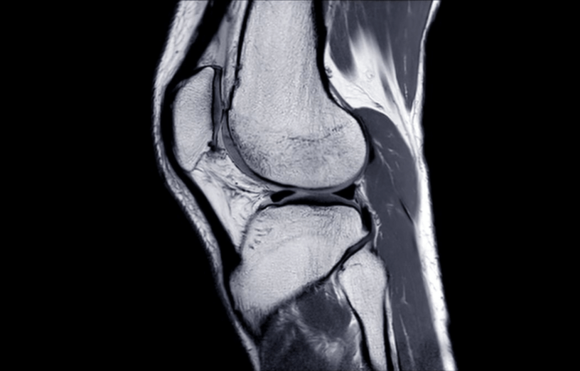 Recovering Stronger After an ACL Injury: